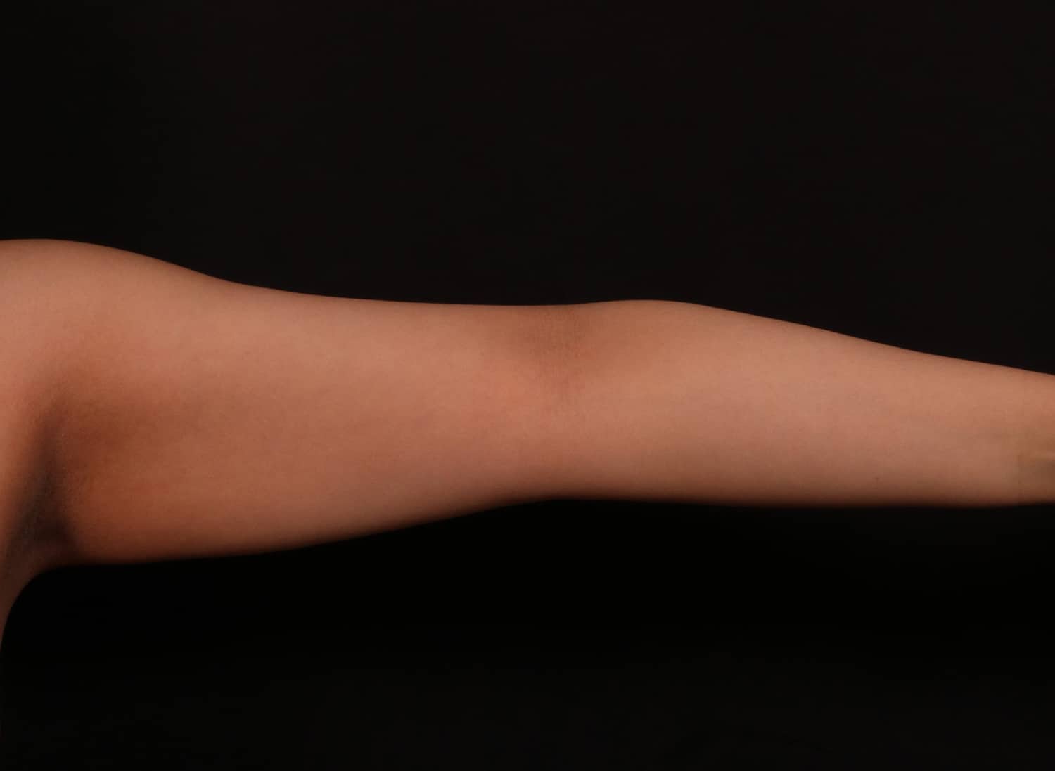 Before Image: Brachioplasty - front