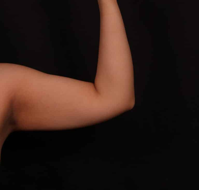 Before Image: Brachioplasty - front