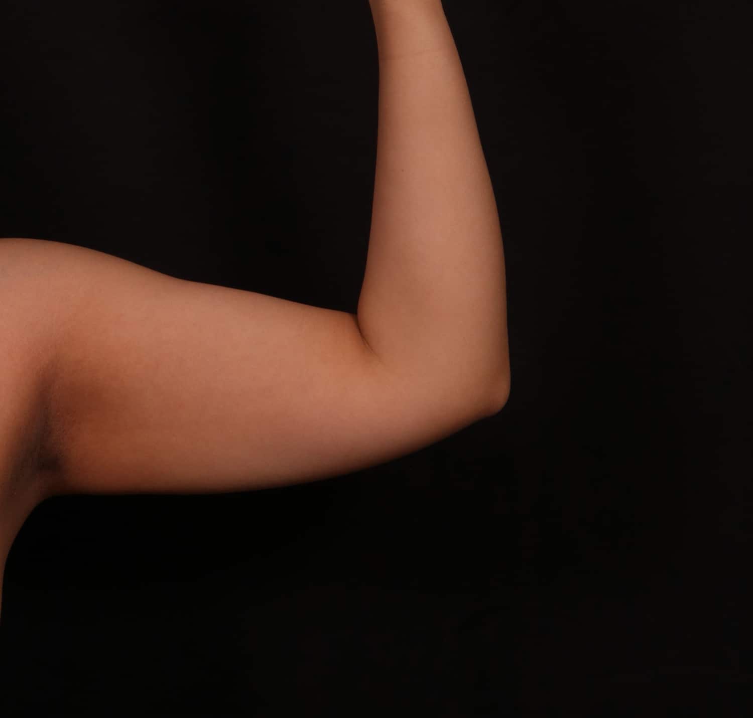 Before Image: Brachioplasty - front