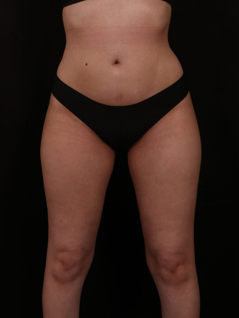 After Image: Brazilian Butt Lift - front