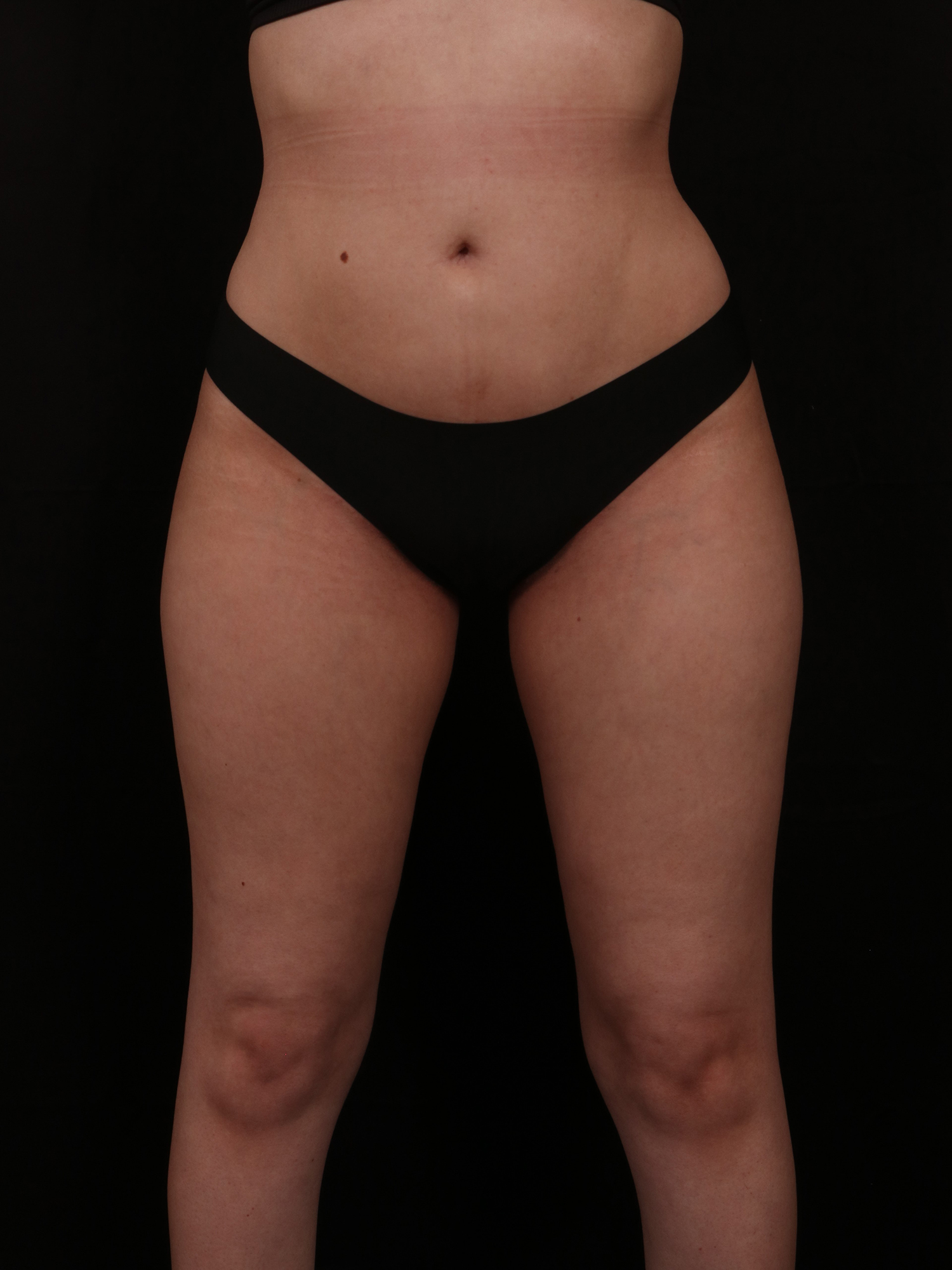 After Image: Brazilian Butt Lift - front