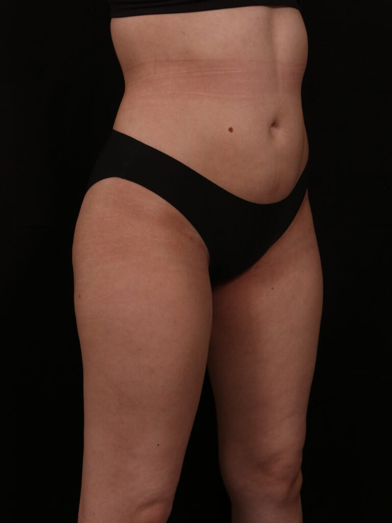 After Image: Brazilian Butt Lift - front