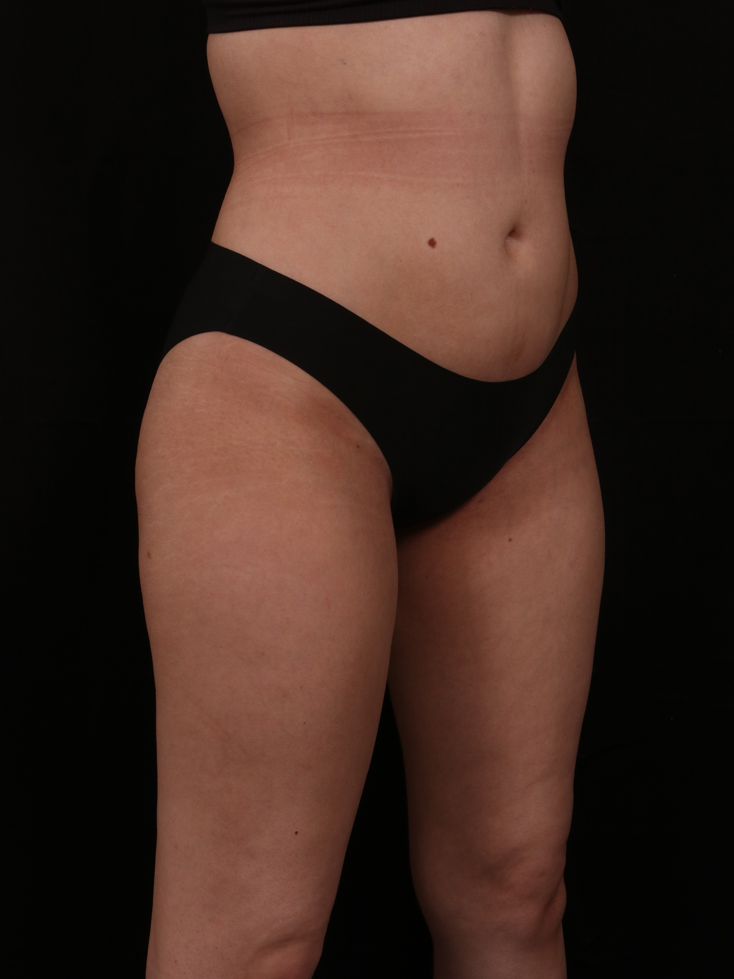 After Image: Brazilian Butt Lift - front