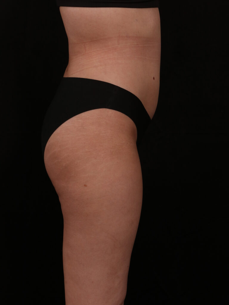 After Image: Brazilian Butt Lift - front