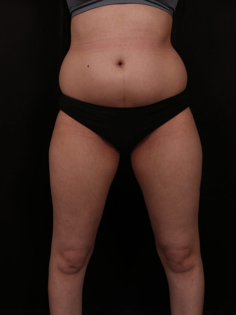 Before Image: Brazilian Butt Lift - front