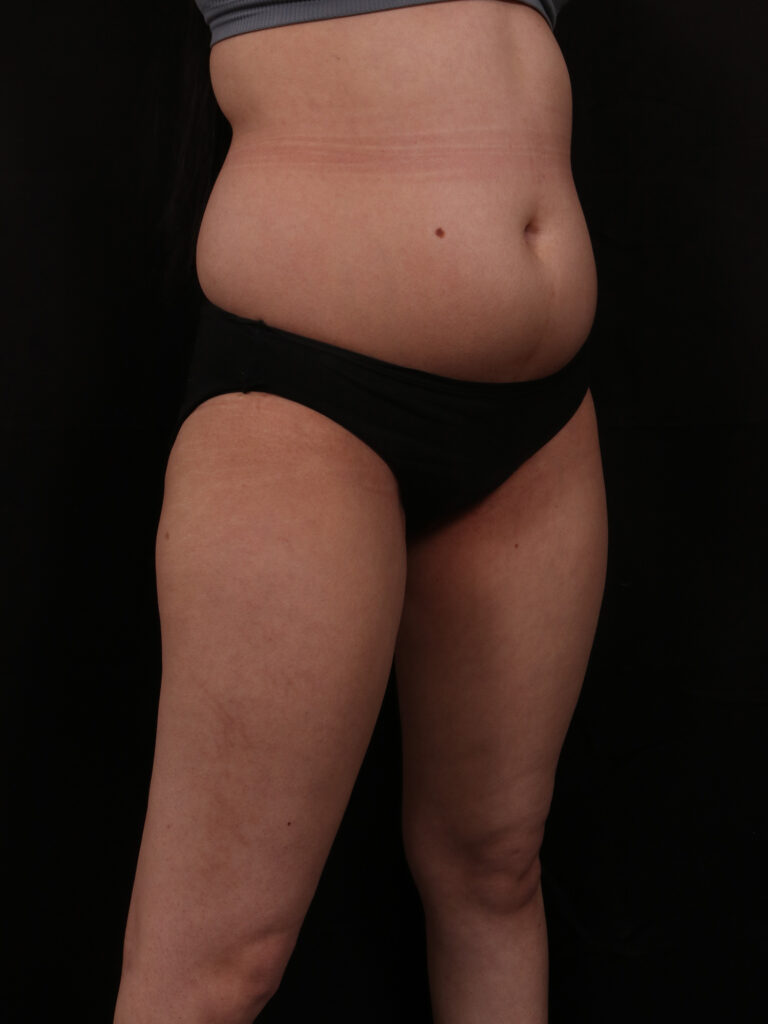 Before Image: Brazilian Butt Lift - front
