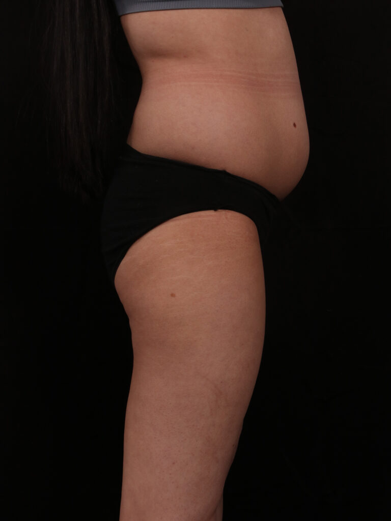 Before Image: Brazilian Butt Lift - front