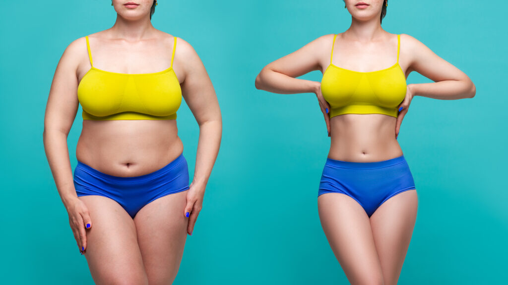 Before and after shots of a woman who has lost weight through procedures like liposuction or CoolSculpting