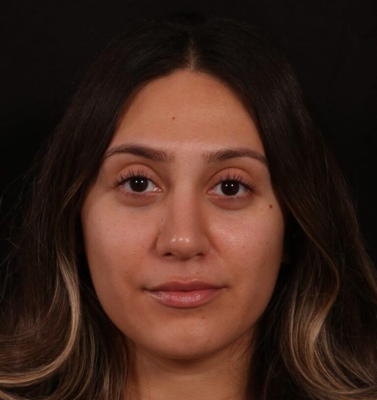 After Image: Rhinoplasty - front