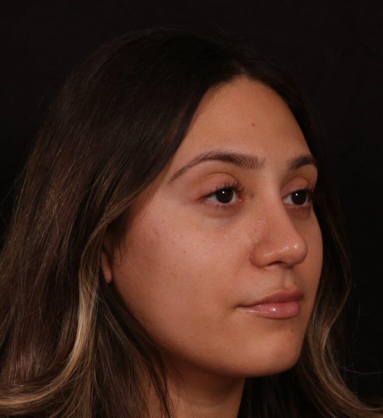After Image: Rhinoplasty - right-front-oblique