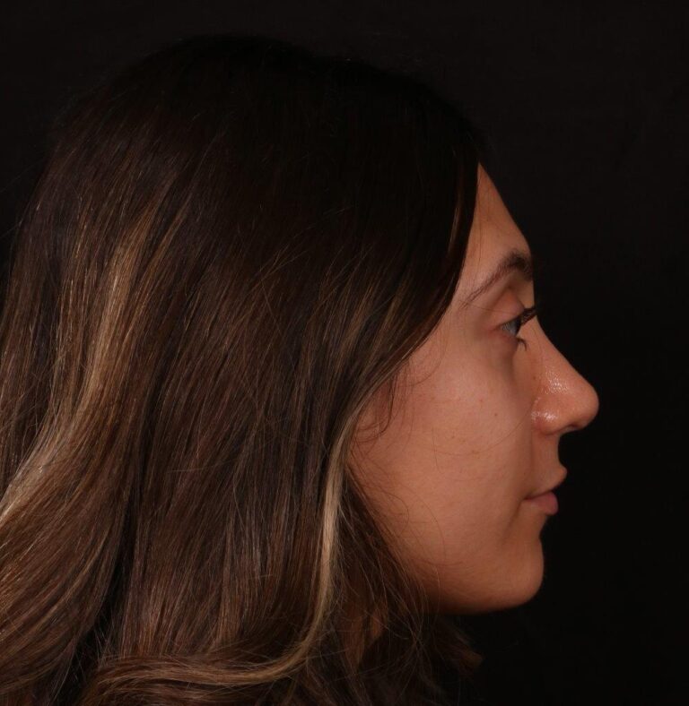 After Image: Rhinoplasty - right-side