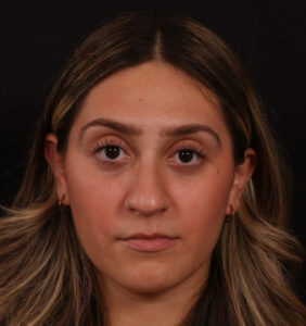 Before Image: Rhinoplasty