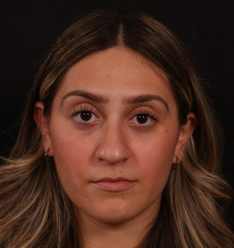 Before Image: Rhinoplasty - front