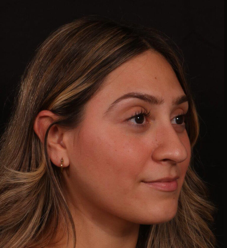 Before Image: Rhinoplasty - right-front-oblique