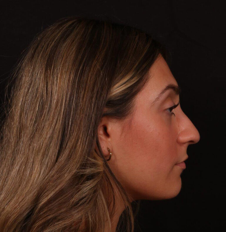 Before Image: Rhinoplasty - right-side