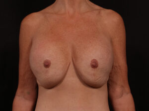 Before Image: Secondary Breast Enhancement