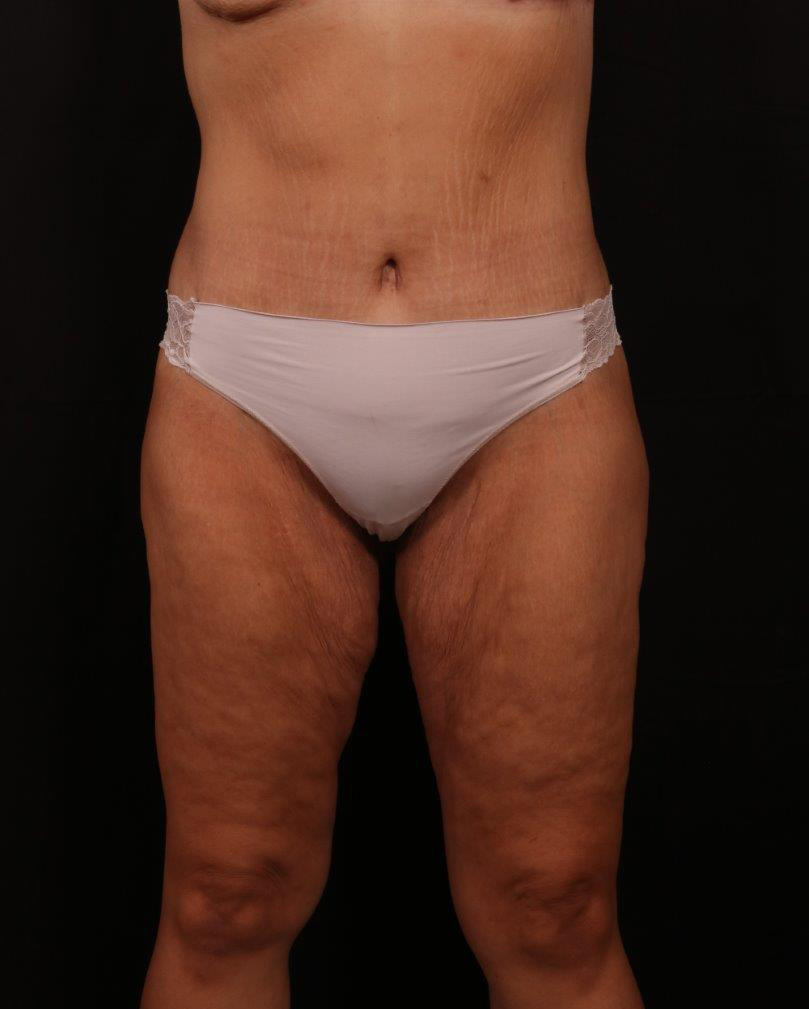 After Image: Tummy Tuck - front
