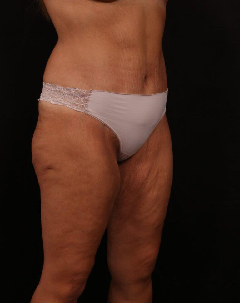 After Image: Tummy Tuck - right-front-oblique