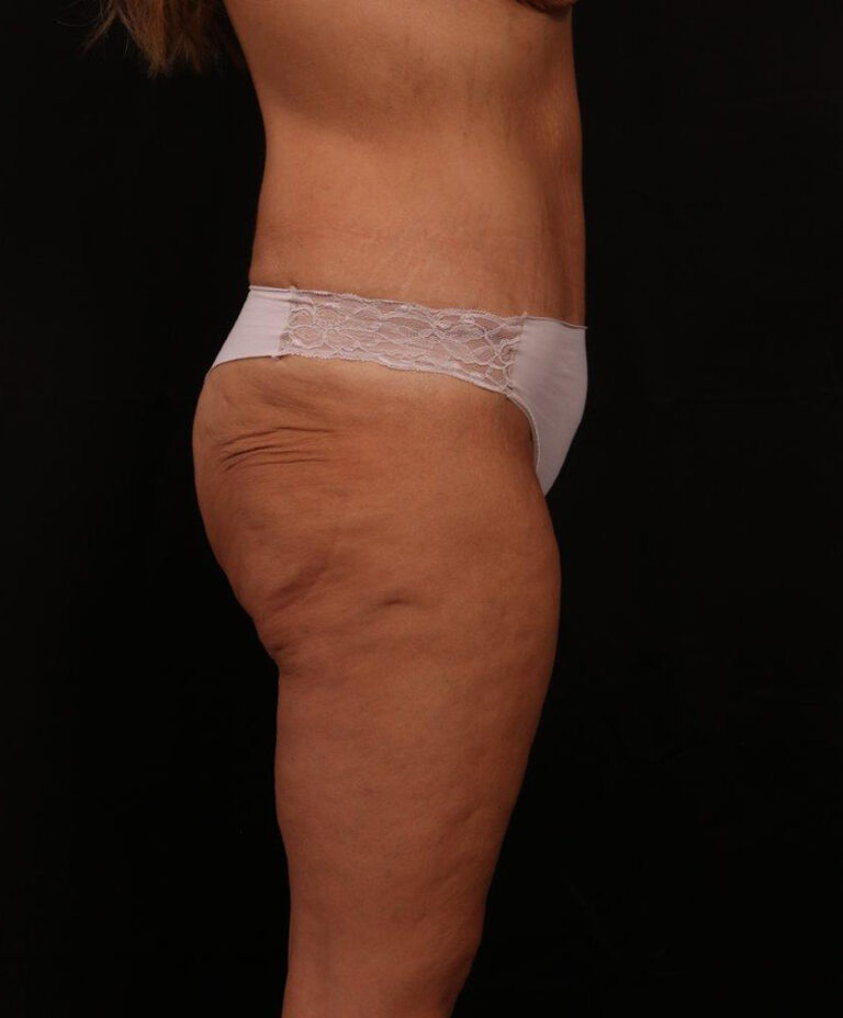 After Image: Tummy Tuck - right-side