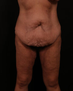 Before Image: Tummy Tuck