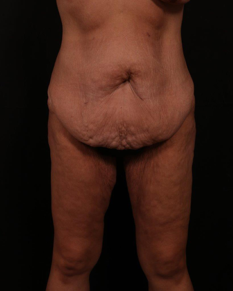 Before Image: Tummy Tuck - front