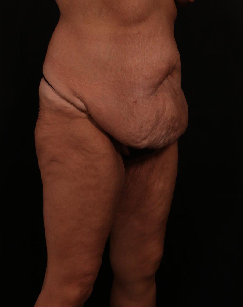 Before Image: Tummy Tuck - right-front-oblique
