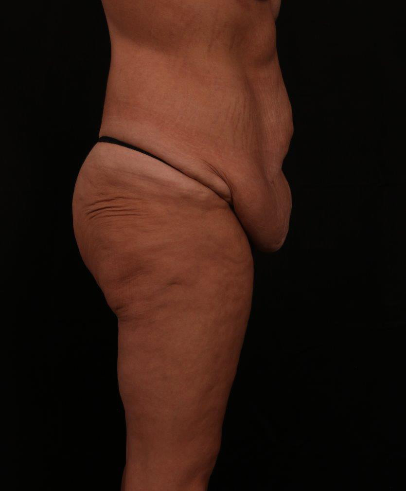 Before Image: Tummy Tuck - right-side