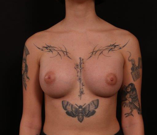 After Image: Breast Augmentation - front