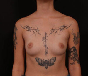 Before Image: Breast Augmentation