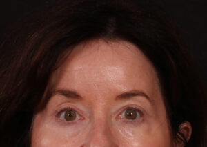 After Image: Brow Lift and Blepharoplasty