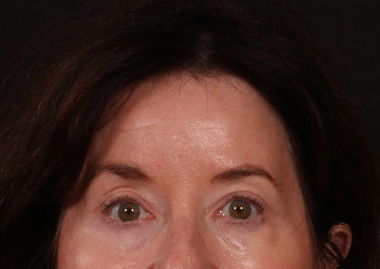 After Image: Brow Lift and Blepharoplasty - front