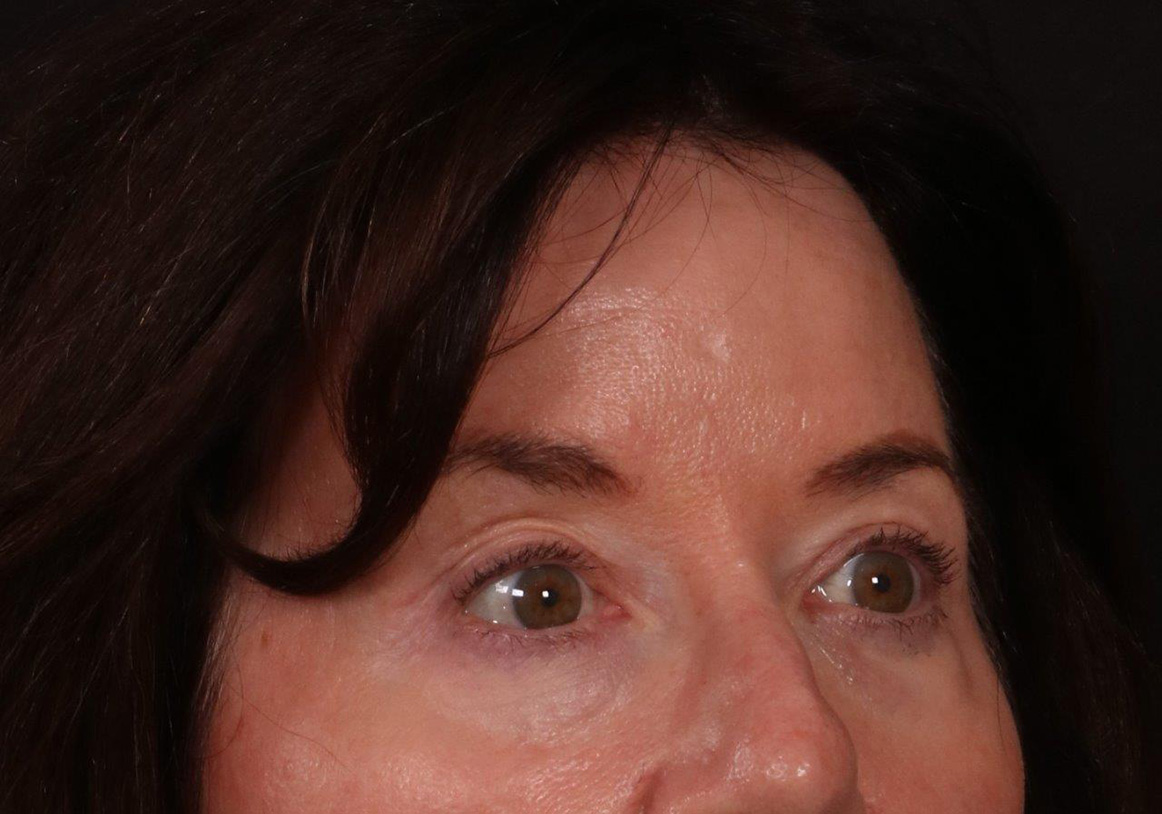 After Image: Brow Lift and Blepharoplasty - right-front-oblique