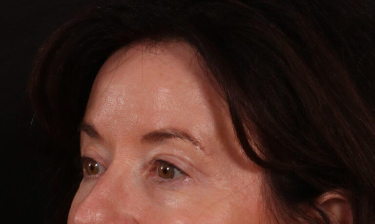 After Image: Brow Lift and Blepharoplasty - left-front-oblique