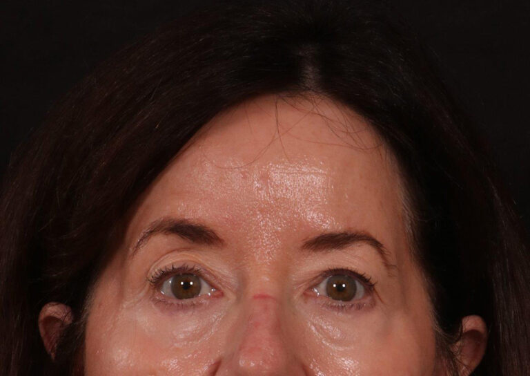 Before Image: Brow Lift and Blepharoplasty - front