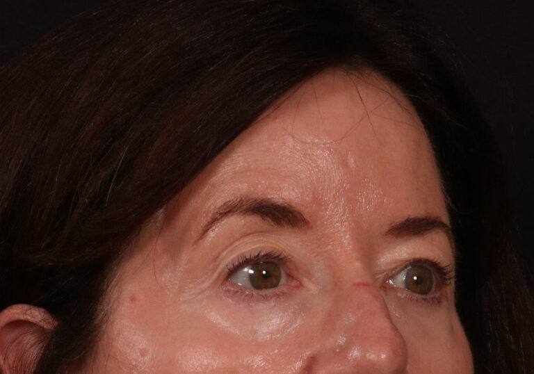 Before Image: Brow Lift and Blepharoplasty - right-front-oblique