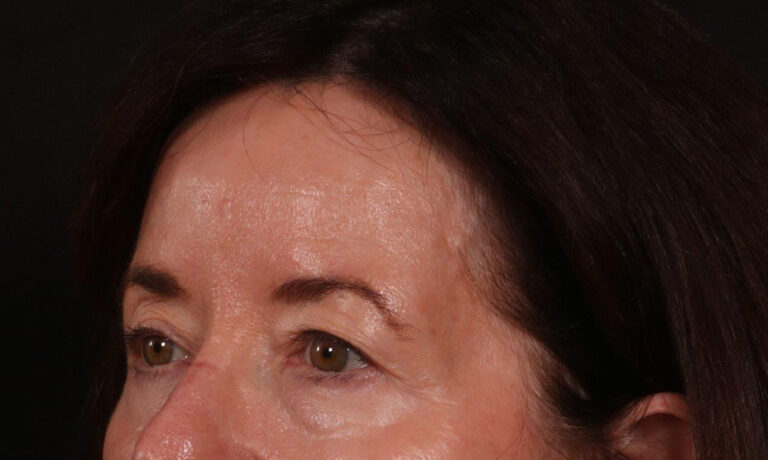 Before Image: Brow Lift and Blepharoplasty - left-front-oblique