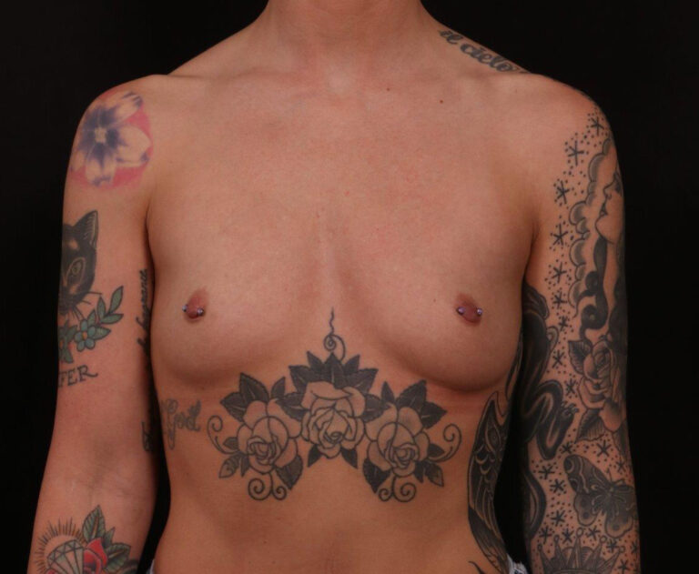 Before Image: Breast Augmentation - front