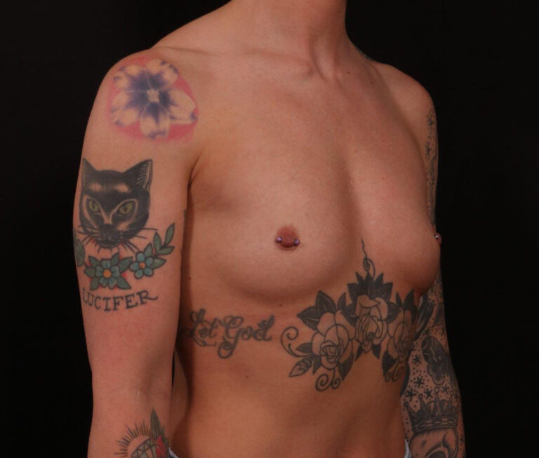 Before Image: Breast Augmentation - right-front-oblique