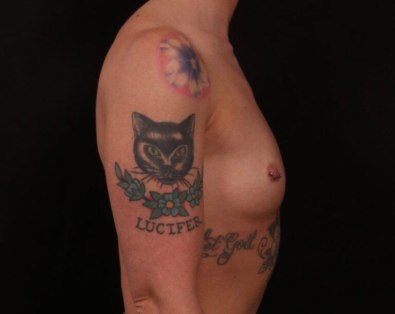Before Image: Breast Augmentation - right-side