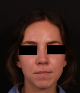 After Image: Rhinoplasty