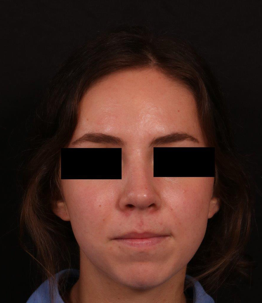 After Image: Rhinoplasty - front
