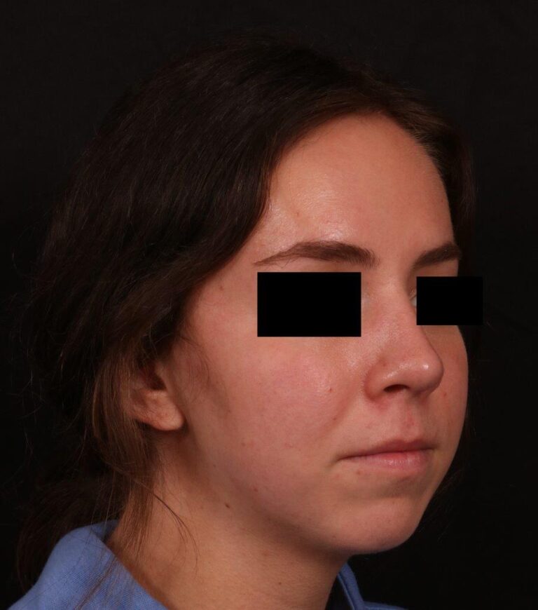 After Image: Rhinoplasty - right-front-oblique
