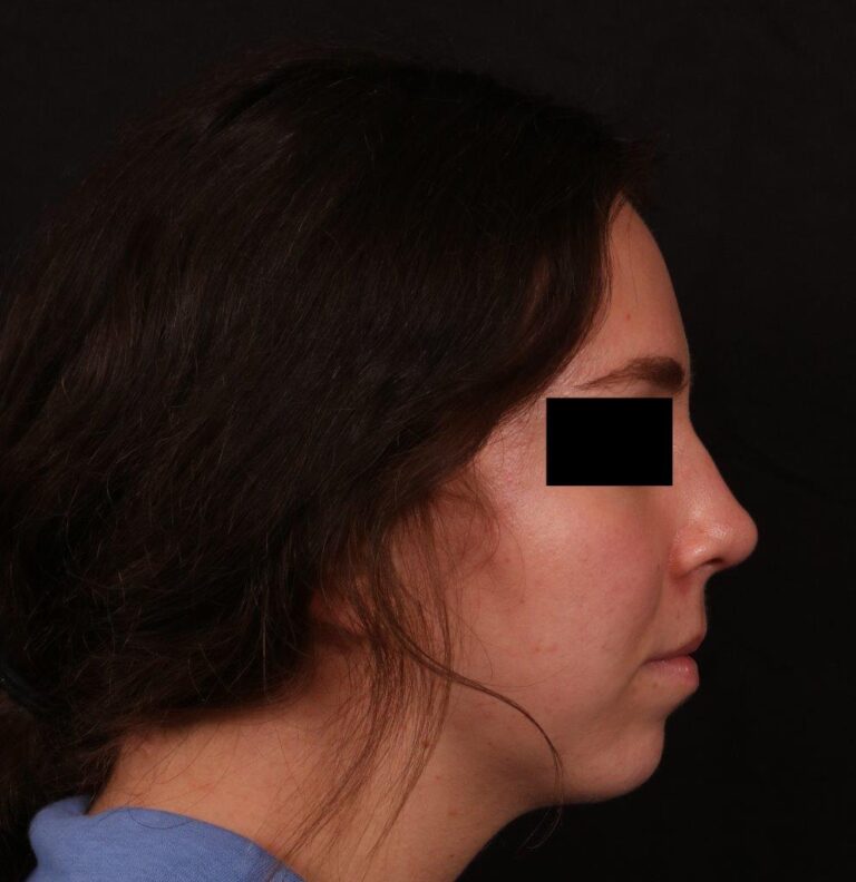 After Image: Rhinoplasty - right-side
