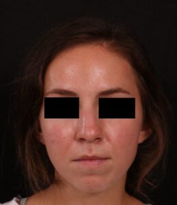 Before Image: Rhinoplasty