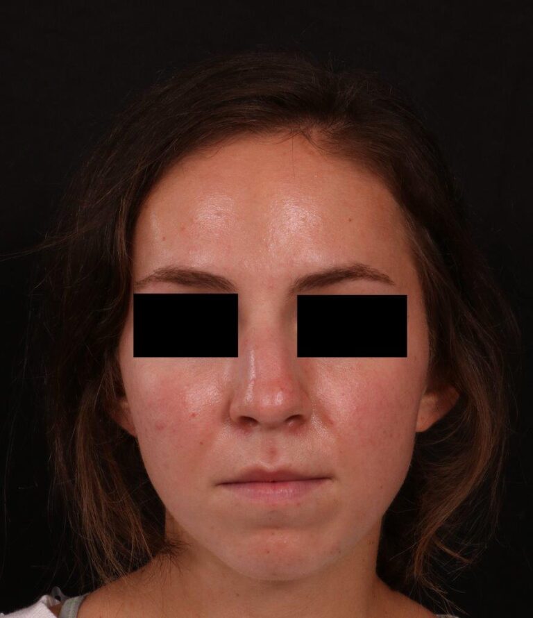 Before Image: Rhinoplasty - front