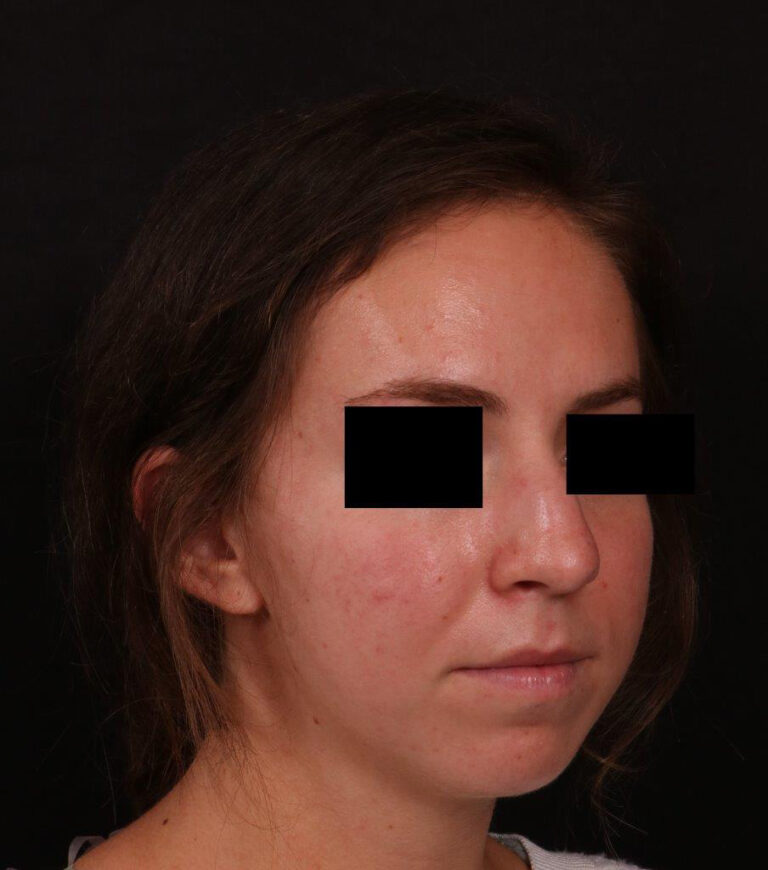 Before Image: Rhinoplasty - right-front-oblique