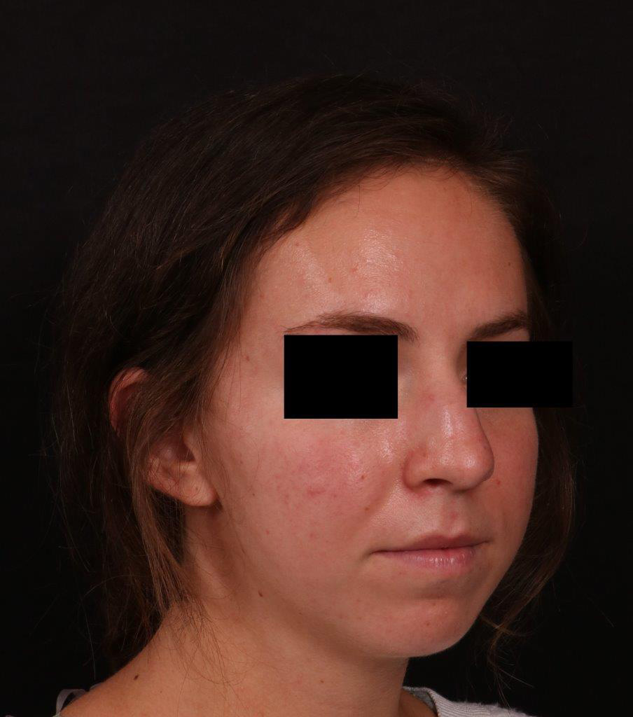 Before Image: Rhinoplasty - right-front-oblique