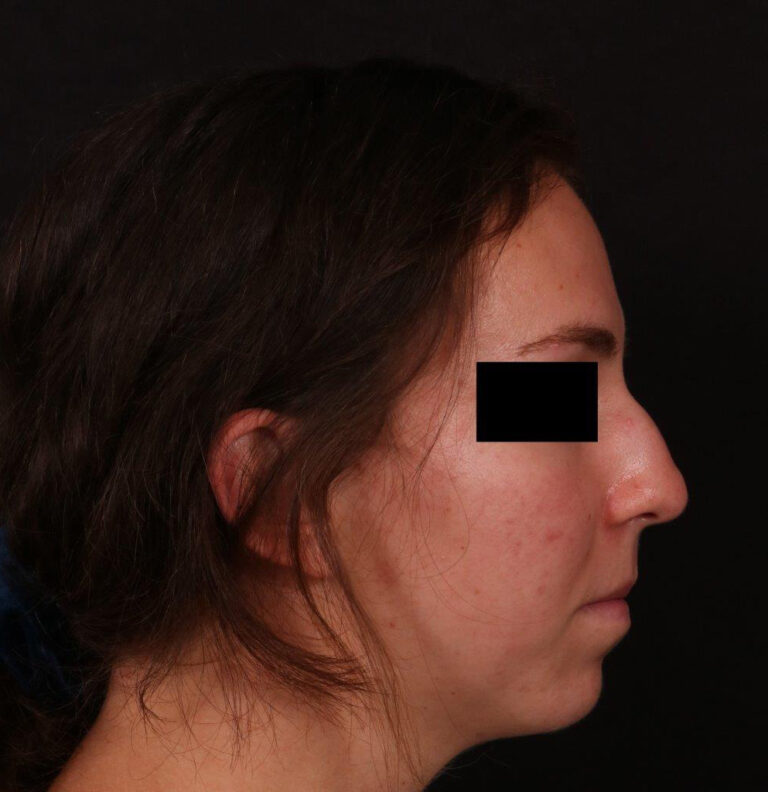Before Image: Rhinoplasty - right-side