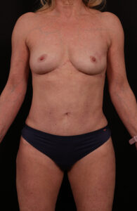 After Image: Reverse Tummy Tuck