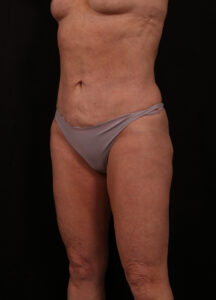 After Image: Reverse Abdominoplasty